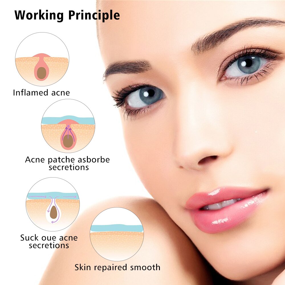 SmilePlus 36 Acne Spot Patches Anti-Inflammatory Hydrocolloid Pimple Treatment