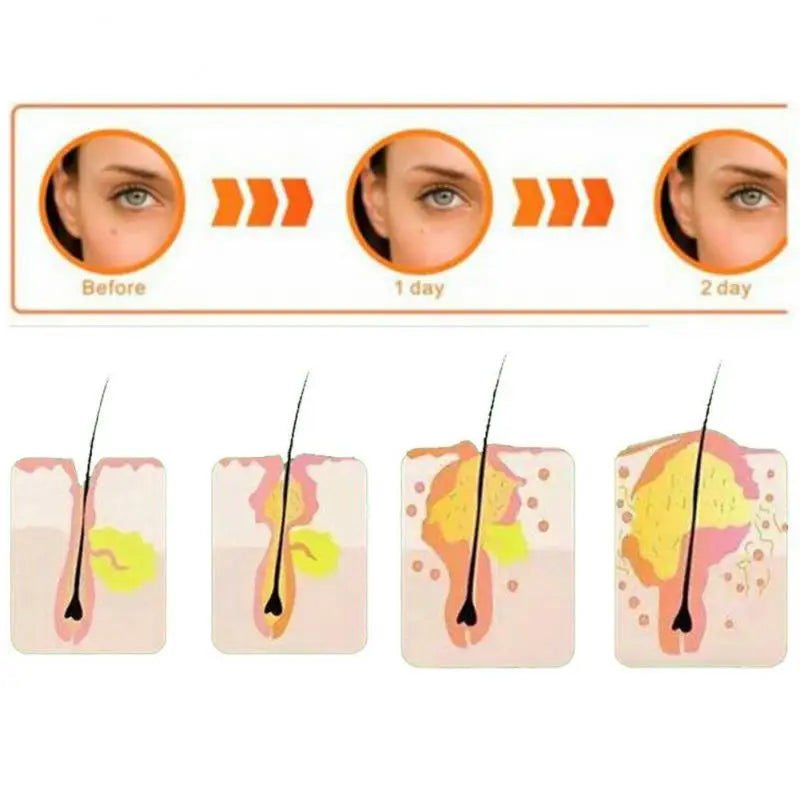 36 Pimple Patch Acne Treatment Invisible Spot Cover Absorbs Oil & Reduces Redness