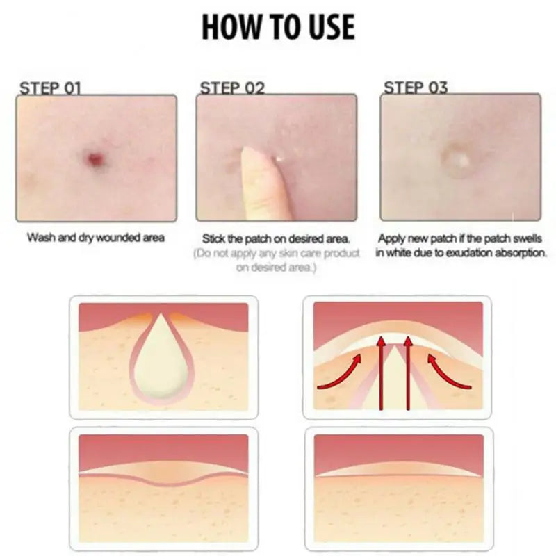 36 Pimple Patch Acne Treatment Invisible Spot Cover Absorbs Oil & Reduces Redness