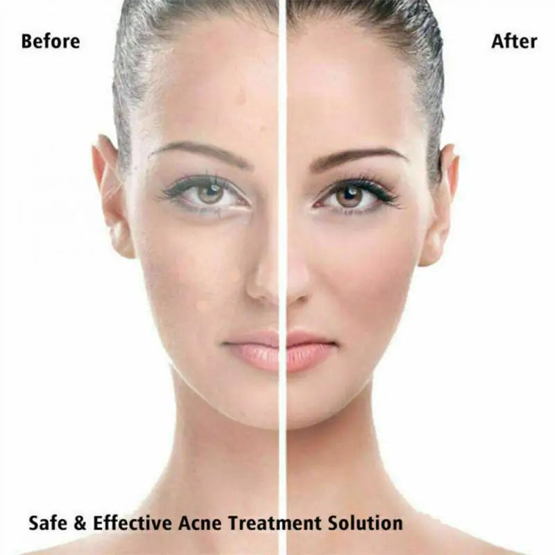 36 Pimple Patch Acne Treatment Invisible Spot Cover Absorbs Oil & Reduces Redness